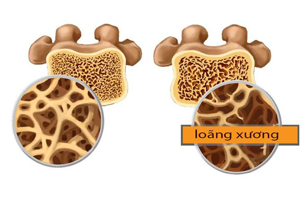 người bị bệnh loãng xương có trồng răng implant được không