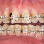 Cấy ghép implant không rạch lợi là gì? Ưu điểm nổi bật