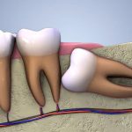 Trẻ em bị sâu răng ăn vào tủy: Nguyên nhân và một số cách điều trị