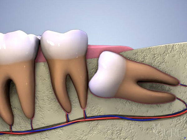 nhổ răng khôn có chắc chắn phải nằm viện hay không