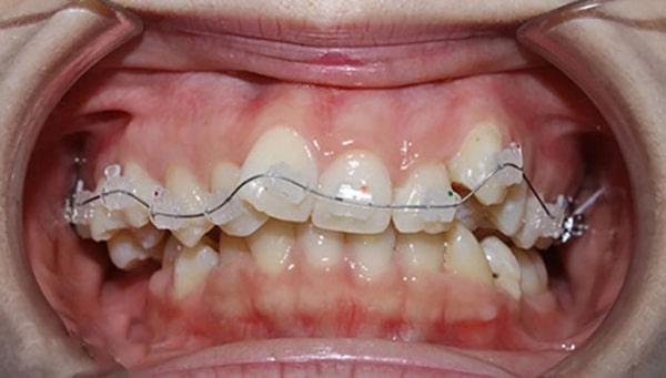 răng mọc chen chúc niềng răng bằng invisalign