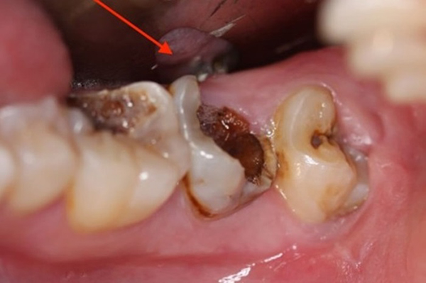 Nhổ răng sâu có đau không? Lưu ý khắc phục