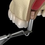 Tác hại của việc trồng răng implant chắc chắn cần biết