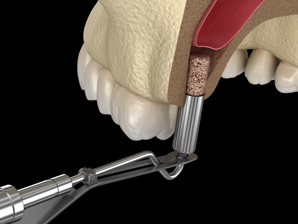 Nâng xoang khi cấy ghép implant áp dụng cho trường hợp nào?