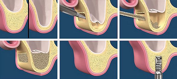 Nâng xoang khi cấy ghép implant có cần thiết không?