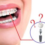 Trồng răng implant mất thời gian bao lâu thì lành?