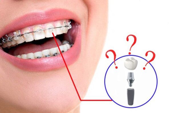 Trồng răng implant có thể niềng răng được không?