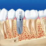 Trồng răng implant có thể niềng răng được không?