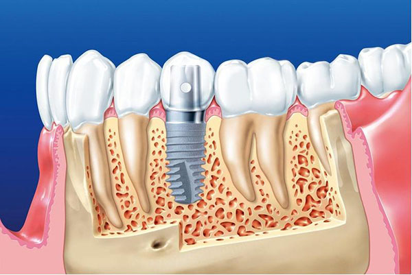 Tác hại của việc trồng răng implant