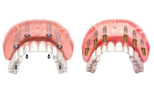 Trồng răng implant giá bao nhiêu?