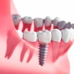 Trồng răng implant hút thuốc lá được không?