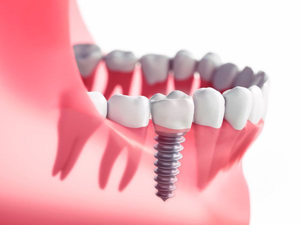 Cấy ghép implant an toàn không?