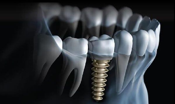 Cấy ghép implant an toàn không phải đảm bảo sức khỏe tốt