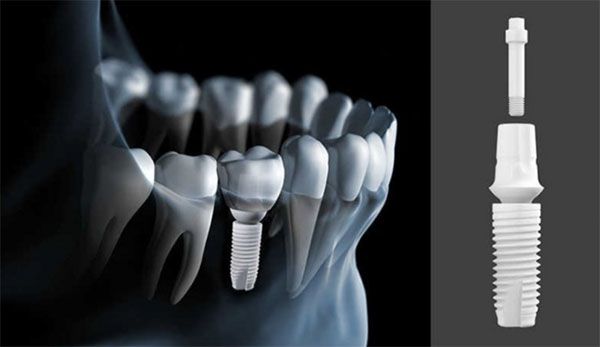 Cấy ghép implant có thật sự an toàn không