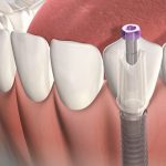 Mới nhổ răng có trồng implant được không?