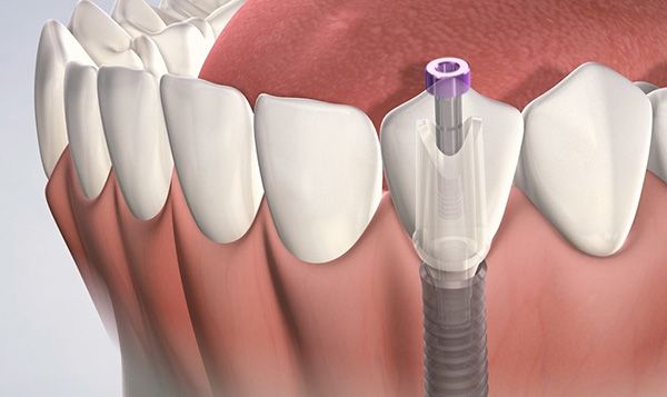 Top 5 lý do cấy ghép implant bị sưng chắc chắn phải biết