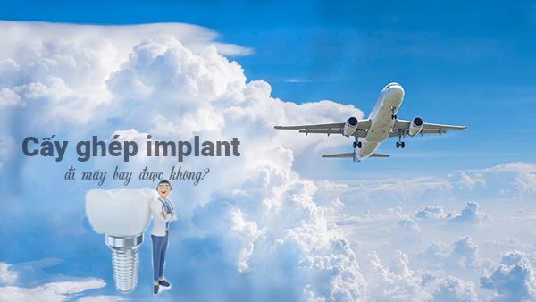 Cấy ghép implant đi máy bay được không?