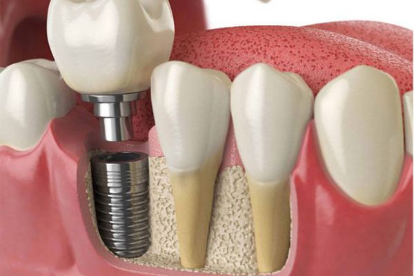 Yếu tố gây ra tình trạng cấy ghép implant đau