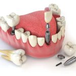 Top 5 lý do cấy ghép implant bị sưng chắc chắn phải biết