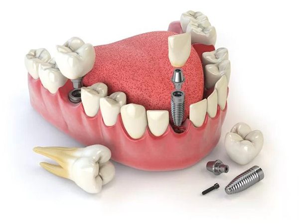 Nhổ răng có trồng implant được không?