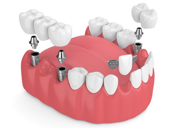 Nhổ răng trồng răng implant có ưu và nhược điểm gì?