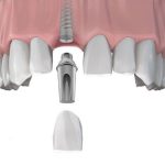 Các bước đánh răng đúng cách sau khi cấy ghép Implant