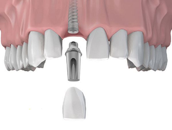 nhổ răng cửa trồng răng implant được không