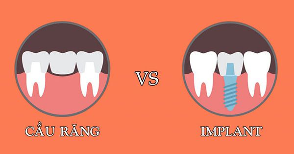 Trồng răng implant và bắc cầu răng sứ đòi hỏi kỹ thuật như thế nào?