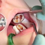 Trồng răng implant mất thời gian bao lâu thì lành?