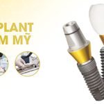 Trụ Implant Nobel chính hãng, giá rẻ|Drngocimplant