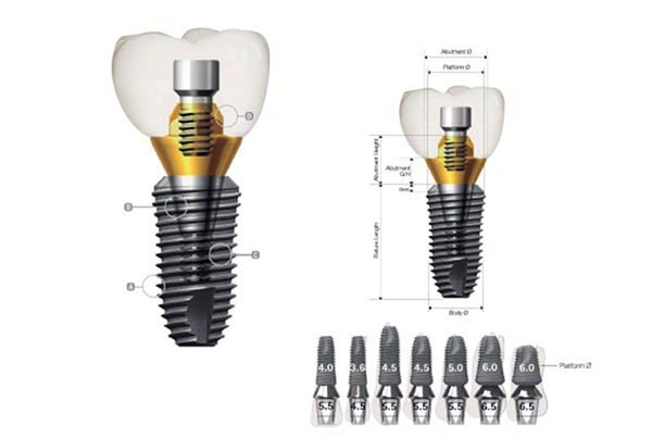 Tuổi thọ trụ Dentium Mỹ cao