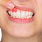 Cấy ghép implant an toàn không?