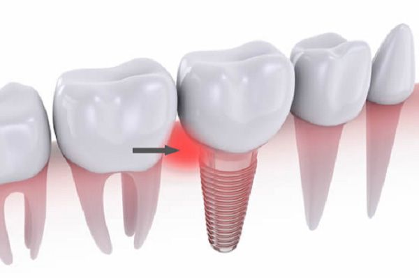 Dấu hiệu của viêm quanh implant là gì? 