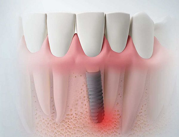 Lưu ý để tránh tình trạng bị viêm quanh răng implant