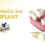 Độ tuổi nào thích hợp trồng răng implant chắc chắn phải biết