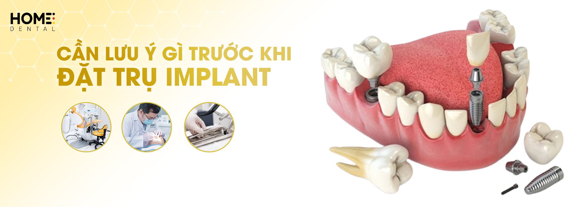 Cần lưu ý gì trước khi đặt trụ implant