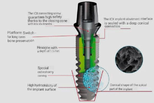 Cấu tạo trụ implant ICX