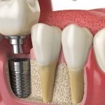 Vì sao phải xét nghiệm máu khi trồng răng implant không?