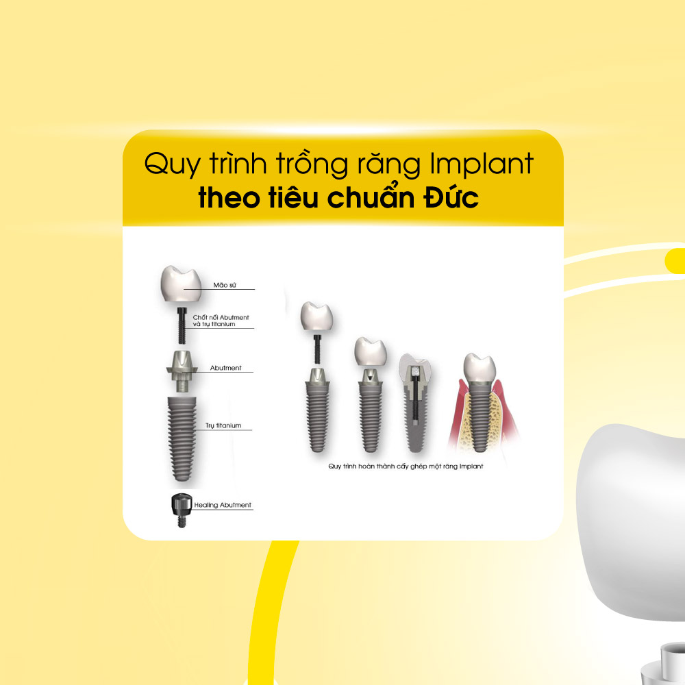 Đặc quyền khi trồng răng implant hình 1