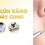 Nhổ răng khôn có cần tiến hành xét nghiệm máu không?