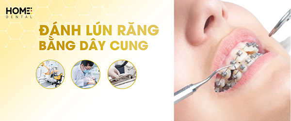 Khi nào nên thực hiện đánh lún răng bằng dây cung