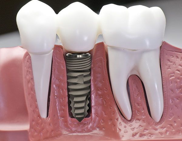 Dấu hiệu nhận biết trụ implant bị đào thải