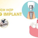 Vì sao không nên súc miệng bằng nước muối sau khi trồng răng implant?