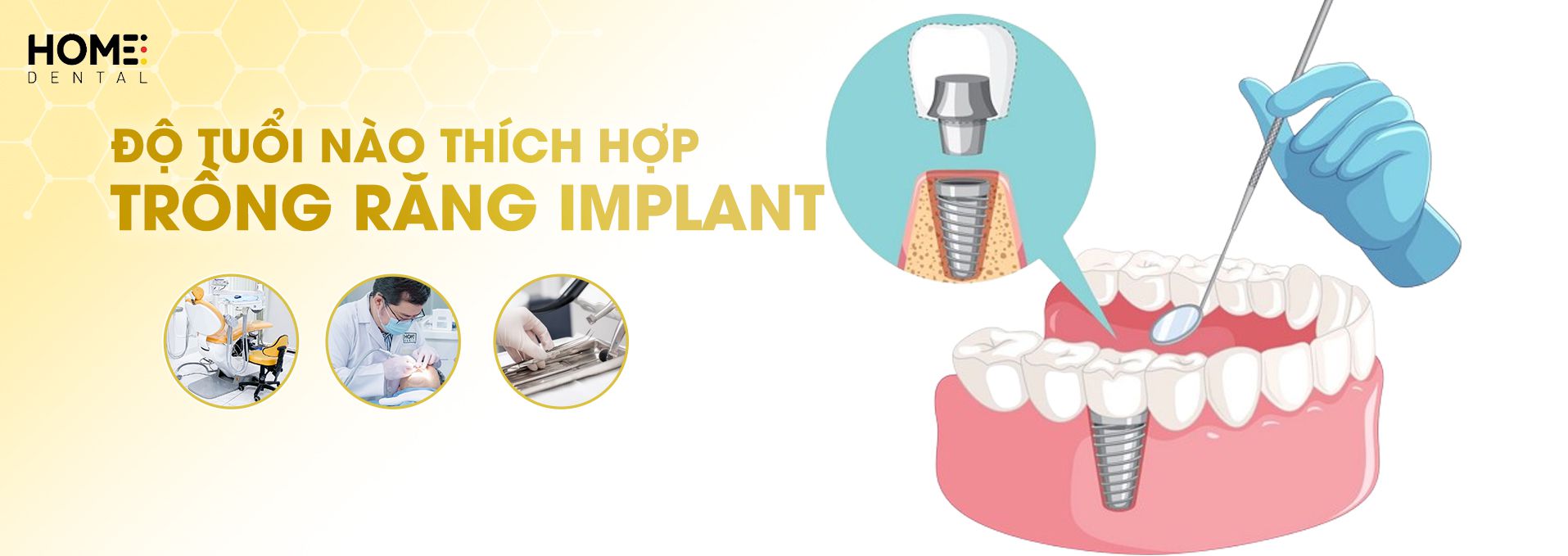 Độ tuổi nào thích hợp trồng răng implant