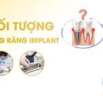 Chườm lạnh sau khi trồng răng implant có giúp giảm sưng không?