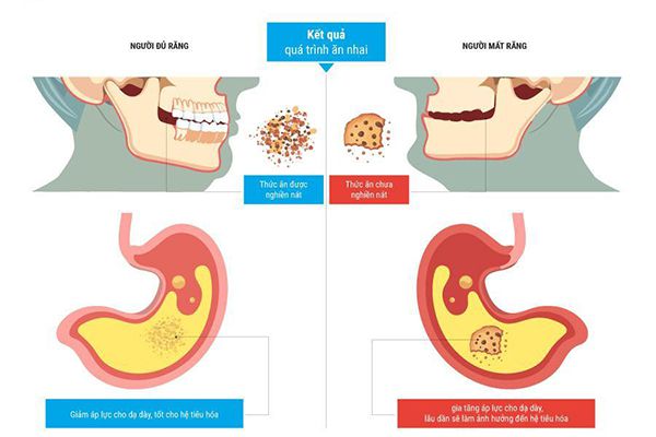 Hậu quả của việc mất răng