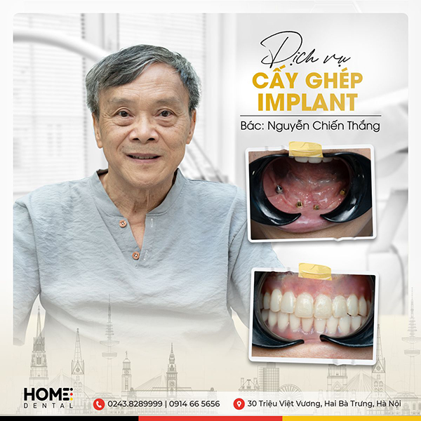 Hình ảnh trồng răng implant hình 7