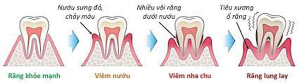 Nguyên nhân răng bị lung lay