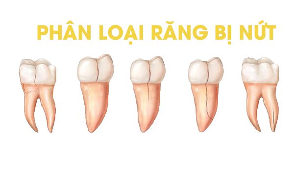 Phân loại tình trạng răng bị nứt