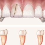 Răng bị lung lay: Nguyên nhân và cách khắc phục như thế nào?